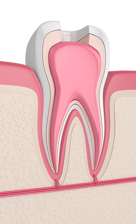 root-canal-in-double-bay